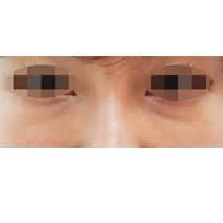 전후사진