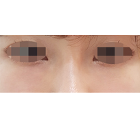 전후사진