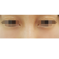 전후사진