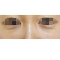전후사진