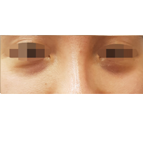 전후사진